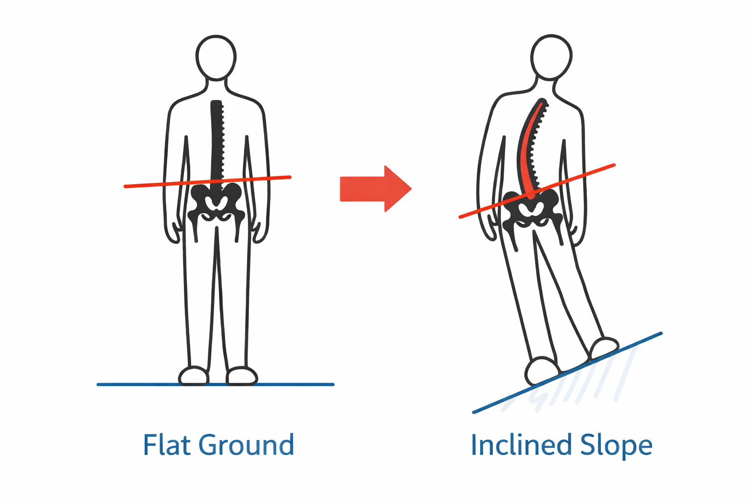 Anatomical diagram showing pelvic tilt and resulting nerve compression